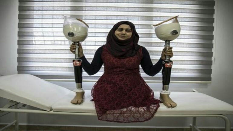 أطراف صناعية مجانية بتركيا لفاقدي أحد أطرافهم في الحرب السورية