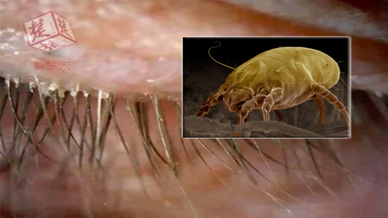 لم تنظف وسادتها لخمس سنوات - امرأة صينية كادت تصاب بالعمى بعد أن دخل العث الى جفونها