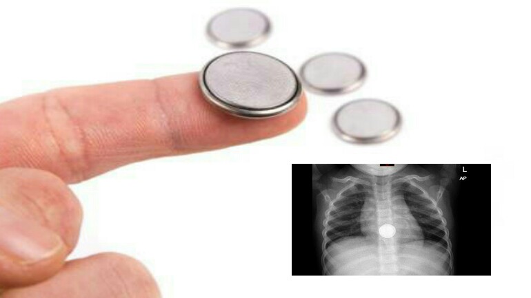 الأطباء يحذرون بشدة من خطر البطاريات الصغيرة على الأطفال