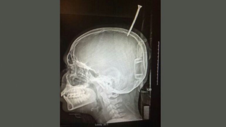 طفل يتلقى مسمار في رأسه - لوكان مليمتر واحد أعمق لكان قاتلا !