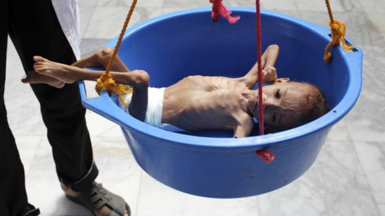 العالم يصمت عن المجاعة التي تهدد 14 مليون شخص في اليمن - يا للعار