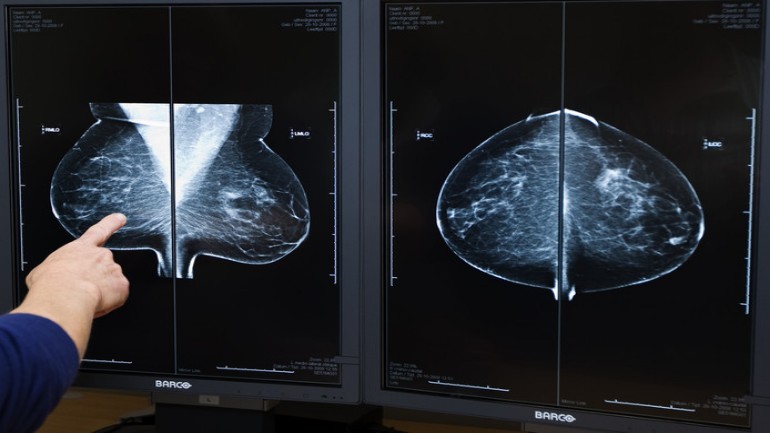 أغلب النساء لا يعرفن اشارات الإصابة بسرطان الثدي - يجب مراقبة التغيرات بانتظام