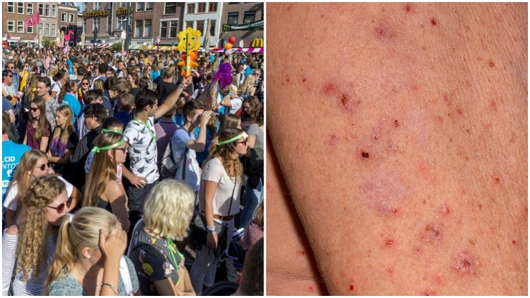 تضاعف حالات الإصابة بمرض الجَرَب الجلدي في هولندا وخصوصاً بين الطلاب