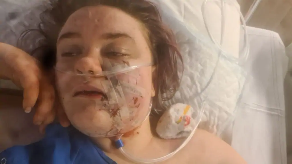 خضوع فتاة لعملية جراحية لساعات في وجهها بعد هجوم كلب عليها في Den Haag