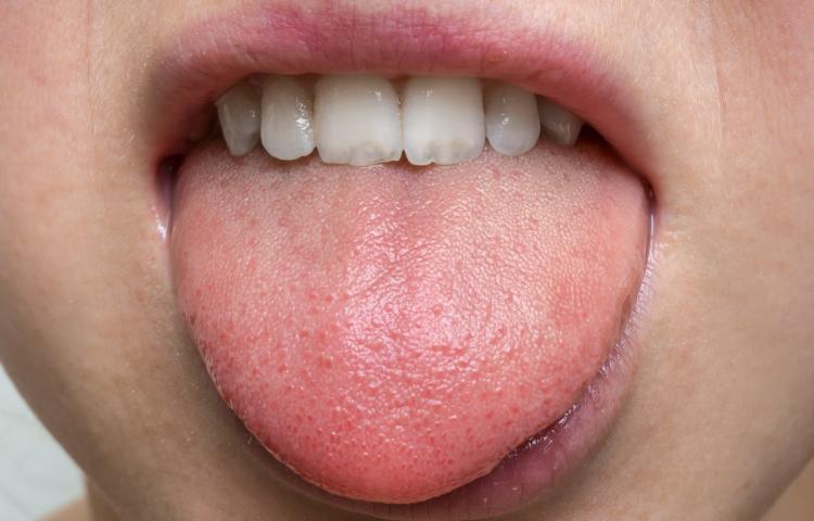 ثلاثة أعراض جديدة قد تدل على الإصابة بالكورونا